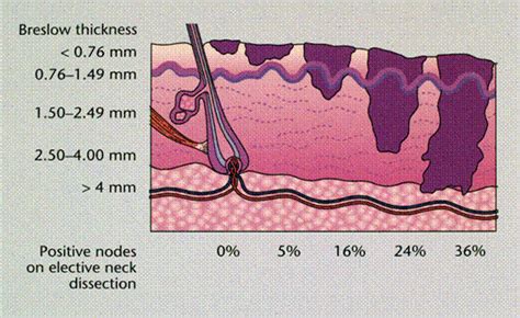 breslow thickness measurement|breslow thickness 0.5 mm.